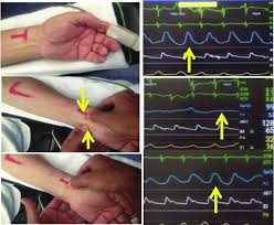 Image result for Allen Test