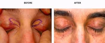 Image result for xanthelasma of eyelid