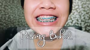 Pelajari gradasi pada roda warna. Vlog 7 Pasang Behel Youtube