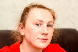 Teenage girl scarred for life after thug launches brutal attack as she  celebrates 17th birthday