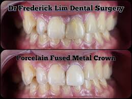 Dental crown atau crown gigi merupakan prosedur pemasangan selubung gigi di atas gigi yang rusak. Dr Frederick Lim Dental Surgery Klinik Pergigian Dr Frederick Lim Posts Facebook