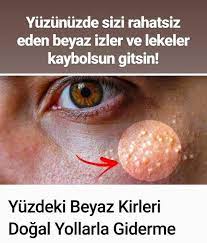 Yuzdeki Beyaz Kirleri Dogal Yontemlerle Kaybetme Natural Remedies Herbal Remedies Herbalism