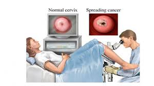 Penjelasan lengkap tentang kanker, hpv, dan kanker serviks secara khusus dijabarkan di sini pertama, menurut gue pembahasan seputar kanker serviks, hpv (virus penyebab kanker harga vaksin hpv bervariasi, tergantung merk dagang yang digunakan dan harganya cukup mahal. Pentingnya Vaksinasi Hpv Di Segala Usia Tribunnews Com Mobile