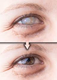 It cannot spread from one eye to the other. Definition Of Cataract Thea