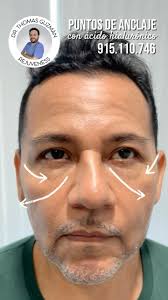 💉✨ Sutil, natural y en solo 30 min ✨💉, Refresca tu rostro con la técnica  de puntos de anclaje del Dr. Thomas Guzmán. Suaviza arrugas, mejora la  flacidez y luce radiante sin cirugía., 📲 Agenda tu cita ...