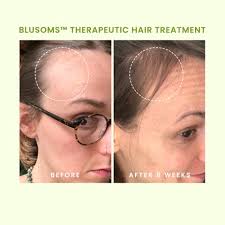 Blusoms™ terapevtik sochni davolash