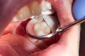 The type of inlay or onlay used depends on how much sound tooth structure remains and consideration of any cosmetic concerns. Dental Costs For Fillings The Results Are In Dental Aware Australia