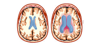 Image result for Hydrocephalus