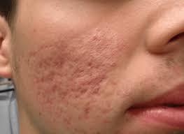 Cara menghilangkan jerawat di punggung dengan cepat. 5 Tips Menghilangkan Parut Jerawat Audela