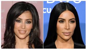 Whether for hygienic or cosmetic reasons, the patient who is tired of temporary, often painful methods of removing unwanted hair will welcome laser hair removal at texas dermatology. Get The Kardashian Hairline With Laser Hair Removal Amerejuve Houston