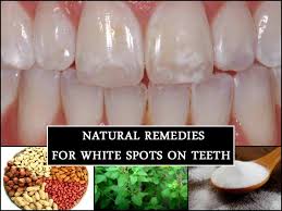Stop reading articles (like how to whiten teeth in one week) or watching youtube videos about whitening teeth, the people who upload them really don't care about you, they care about clicks, and they'll do anything to get them. Do You Have White Spots On Your Teeth These Natural Remedies Help Get Rid Of It Boldsky Com