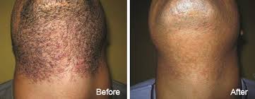 Because a laser is burning portions of the treated hair. Gentlelase Pro