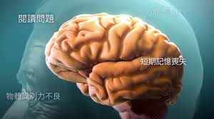 Definition of 阿茲海默症 in the definitions.net dictionary. äº†è§£é˜¿èŒ²æµ·é»˜ç—‡ Understanding Alzheimer S Disease Youtube