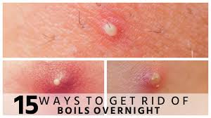 15 Ways To Get Rid Of Boils Overnight Get Rid Of Boils Home Remedy For Boils Skin Boil