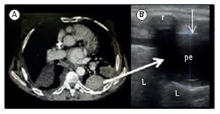 Scielo Brasil Lung Ultrasound In The Evaluation Of Pleural Effusion Lung Ultrasound In The Evaluation Of Pleural Effusion