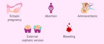 Image result for Rh Sensitization