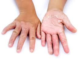 Genetic disease, including a rare skin disorder called acral peeling skin syndrome that causes painless peeling of the. Scaling Skin Pictures Causes Diagnosis And Treatment