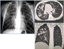 Cystic fibrosis is an inherited condition in which the lungs and digestive system can become clogged with thick, sticky mucus. Epos Trade