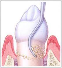 Significant of Fluoride in Oral Health