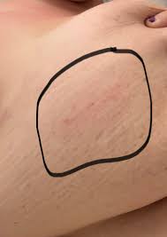 Image result for Inflammatory breast cancer