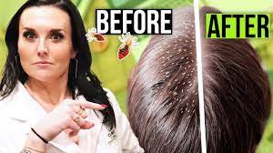 The eggs are encased in a hard shell which protects them from the chemicals used in the hair dye. Does Hair Dye Kill Lice Nits And Eggs Detailed Guide Beezzly