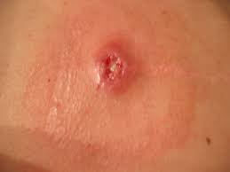 Ingrown hairs do hurt, itch and may bleed. An Infected Ingrown Hair 118 Views 25 Times More Views Th Flickr