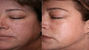 CoolPeel — Koru Medical Spa