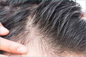 Quali sono le cause della perdita dei capelli? Perdita Dei Capelli Nell Uomo Cause E Prevenzione