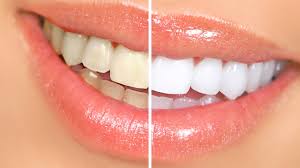 Maybe you would like to learn more about one of these? How To Whiten Teeth With Braces How To Whiten Teeth At Home Youtube
