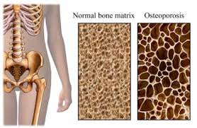 Image result for osteoporosis photos
