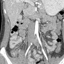 Car insurance premiums are generally higher for younger drivers. 18 Year Old Male Presents With A Sudden Onset Of Rlq Pain And Rebound Tenderness 5 Of 5