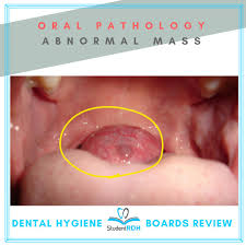 Image result for Filiform Papillae