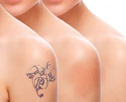 How do you remove a tattoo naturally? Removing Unwanted Tattoos