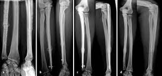 Intramedullare Nagelosteosynthese Der Ulna In Der Revisionschirurgie Springerlink