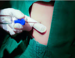 Image result for Spinal Epidural Abscess