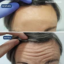¿cuándo debe hacerse el tratamiento con botox®? Resultado De Botox En La Frente Especialista En Trasplante De Pelo Y Estetica