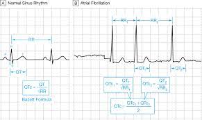 Figure Measuring The Qt Interval In Different Clinical Scenarios Download Scientific Diagram
