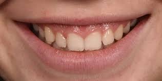 Blanqueamiento Dental ≫ Antes y Después | Excellence Dental ® | Excellence Dental - Centro de Estética Dental
