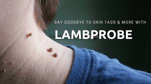 A good mole removal pen can take care of a single small mole in one treatment, but depending on the strength of the pen and the size of the mole, it may take two or more treatments to remove a. Say Goodbye To Skin Tags And More With Lamprobe Clinical Skin Therapeutics Medical Spa