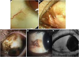 Image result for melanosis sclera