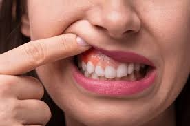 They use the same system of wires to gradually tighten and straighten the teeth, and are typically worn for anywhere from six to 24 months, depending on the complexity of treatment. What Are The Best Alternatives To Braces The Teeth Blog