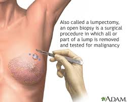 Then, take a cloth/plastic bandage and tape on with medical tape that is safe for skin. Hie Multimedia Breast Cancer