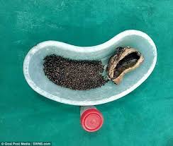 Anda minum obat untuk menurunkan kolesterol anda. Ada 4 100 Batu Empedu Dalam Tubuhnya Ini Yang Ia Rasakan Bertahun Tahun Semua Halaman Nakita