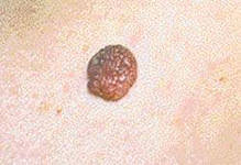 Nevusy Rodinki Spb Gbuz Kozhno Venerologicheskij Dispanser 4