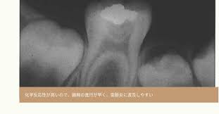 小児歯科学】小児の口腔：幼若永久歯の特徴 | DENTAL YOUTH SHARE