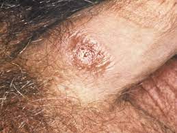 Red spots on penis: 10 causes