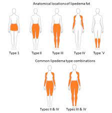 Etx Obesity Ch18 Fig3 Endotext