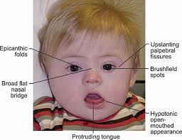 Involuntary, rhythmic, rapid eye movements (nystagmus); Jaypeedigital Ebook Reader