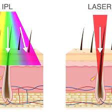 It can be done on your upper lip, legs, bikini. Wink Laser Medispa Laser Vs Ipl Are You Receiving Laser Hair Removal Or Are You Receiving Ipl Hair Removal Laser Hair Removal Is Not Ipl Hair Removal The Main Difference