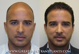 Latest Hair Transplant Technology For Men & Women in Delaware New Castle  Riverview Gardens